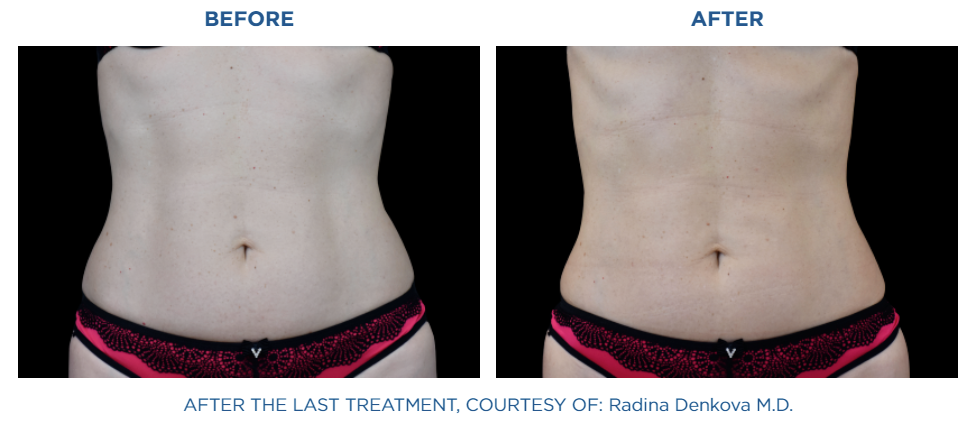 Emsculpt NEO before and after treatment real patient result at Reston Dermatology