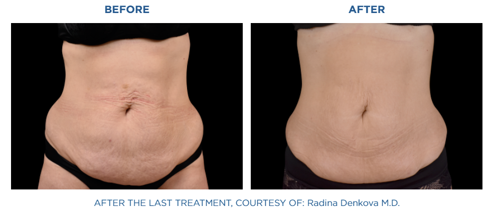 Emsculpt NEO abdomen area before and after treatment at Reston Dermatology