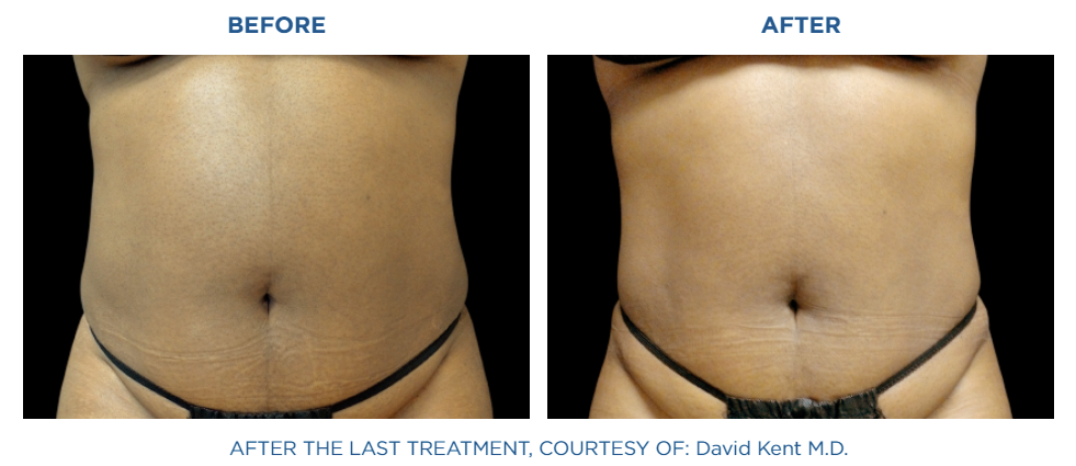 Non-Surgical Body Contouring, Emsculpt in Reston VA