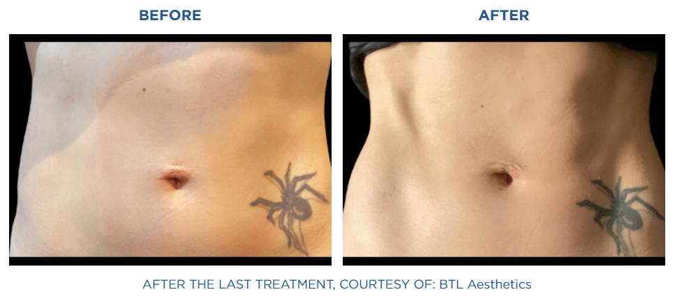 before and after picture of Emsculpt NEO treatment at Reston Dermatology