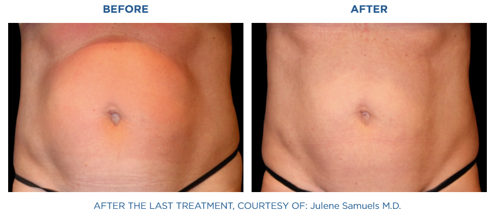 Emsculpt NEO treatment real patient result at Reston Dermatology