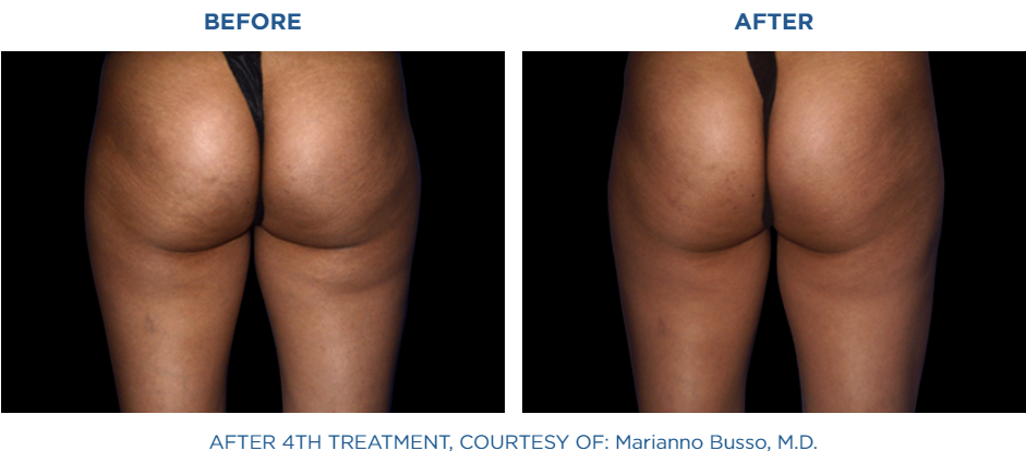 Emtone before and after treatment in Reston Dermatology
