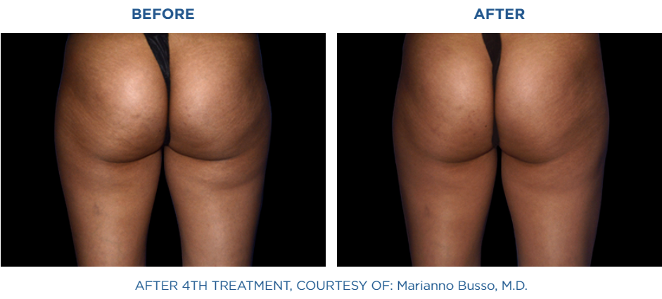 Best Cellulite Treatment in Northern Virginia - Reston Dermatology