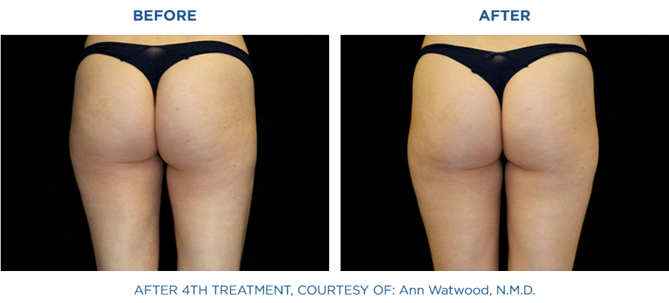 Woman buttocks before and after treatment with Emtone