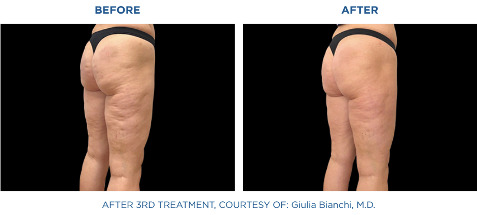 Emtone before and after treatment in buttocks area