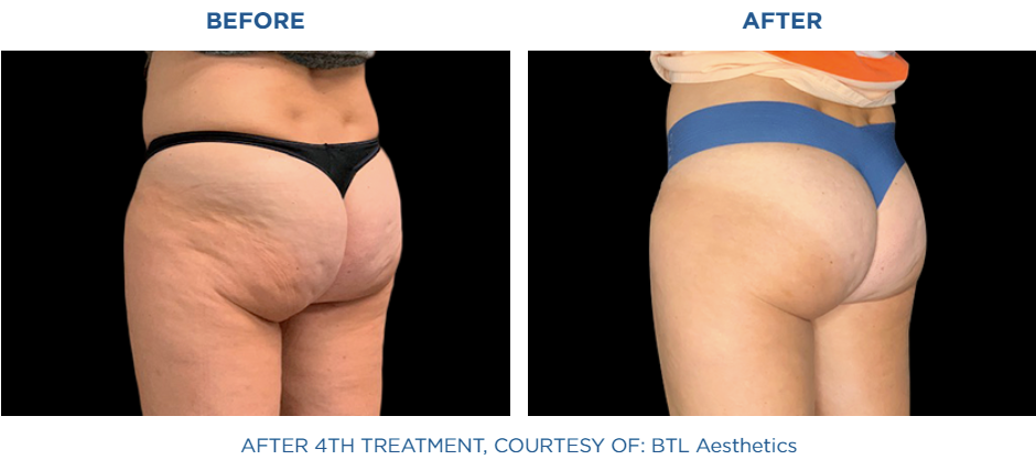 Female buttocks before and after treatment with Emtone