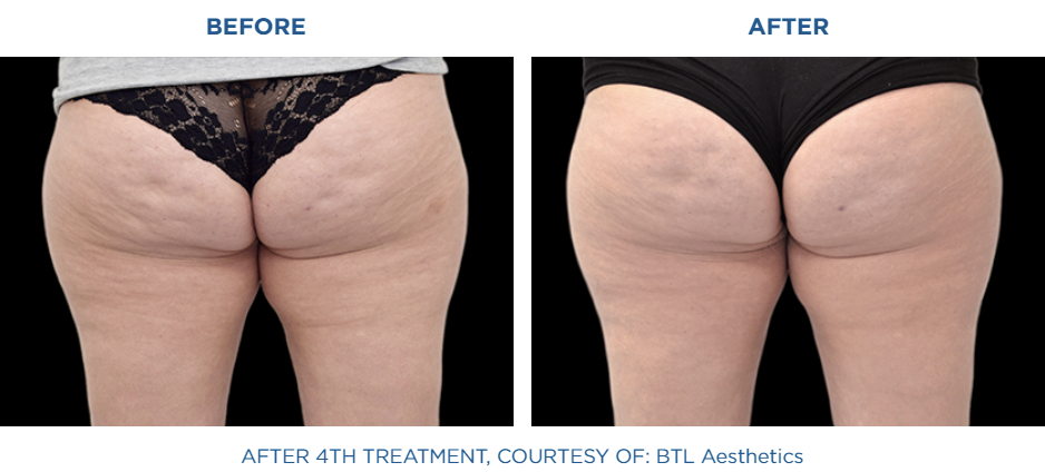 Female buttocks before and after Emtone treatment