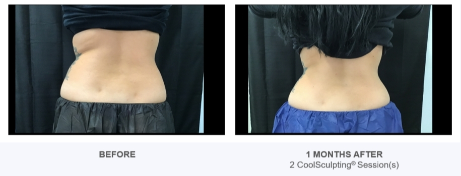 coolsculpting before and after images from reston dermatology
