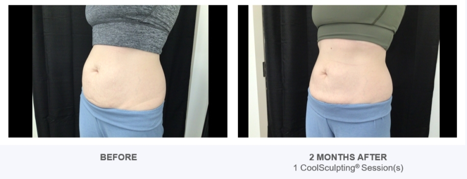coolsculpting real patient result images from reston dermatology
