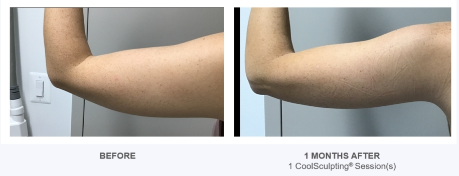 CoolSculpting - Reston Dermatology & Cosmetic Center