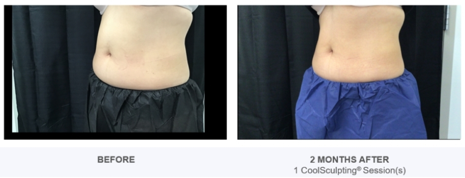 coolsculpting before and after images in reston, VA
