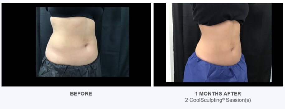 coolsculpting before and after treatment images at reston dermatology