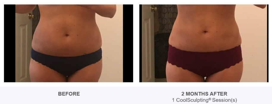 CoolSculpting for C Section Pouch - Reston Dermatology + Cosmetic Center