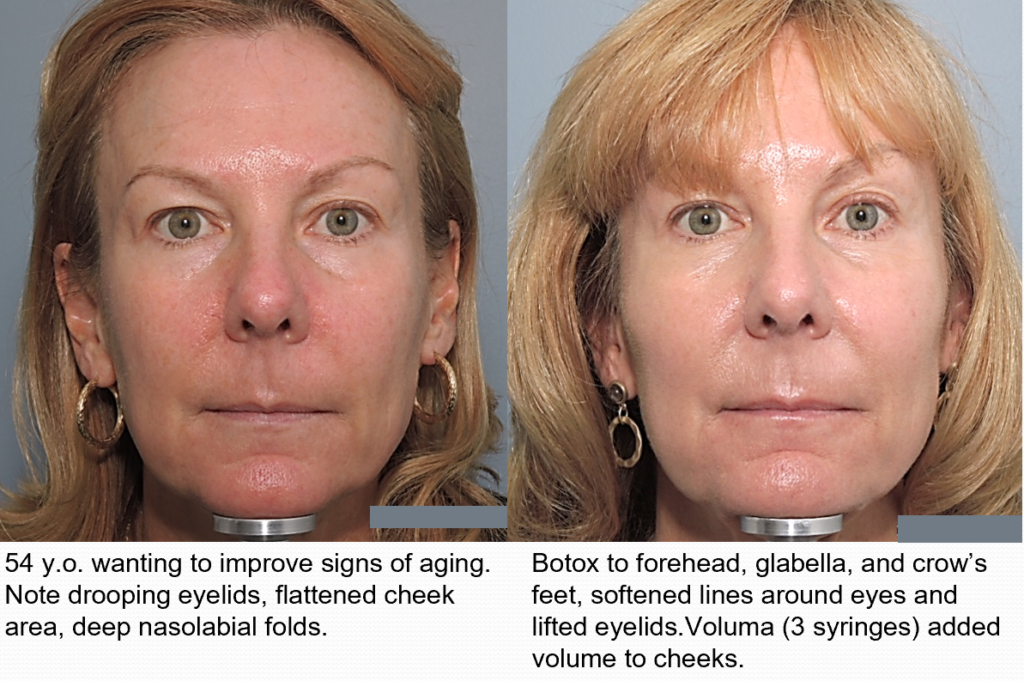 woman's face treated with botox injection at reston dermatology