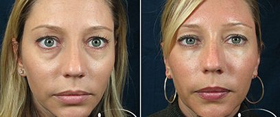 dermal-fillers-before-and-after-images-6