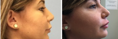 dermal-fillers-before-and-after-images-8